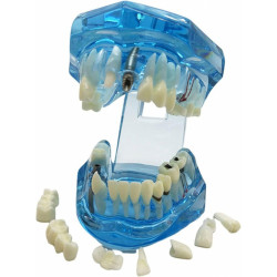 Model zubů, zubní implantáty, modrý